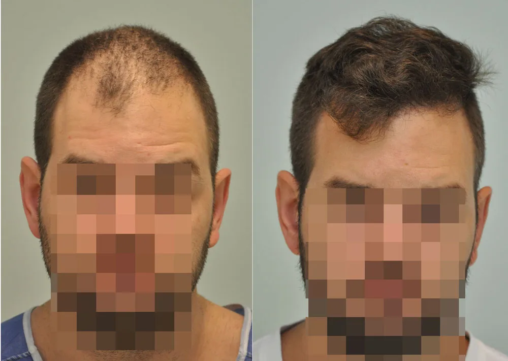 FUE by Doctor — Dr. Sikos Geza Clinic