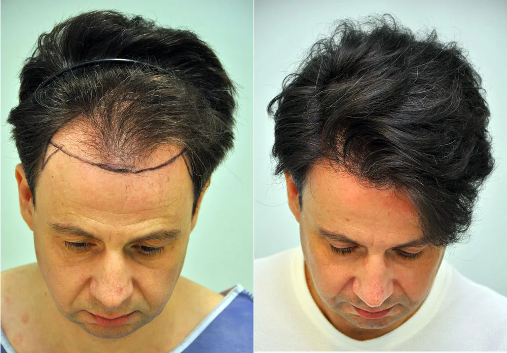 FUE by Doctor — Dr. Sikos Geza Clinic