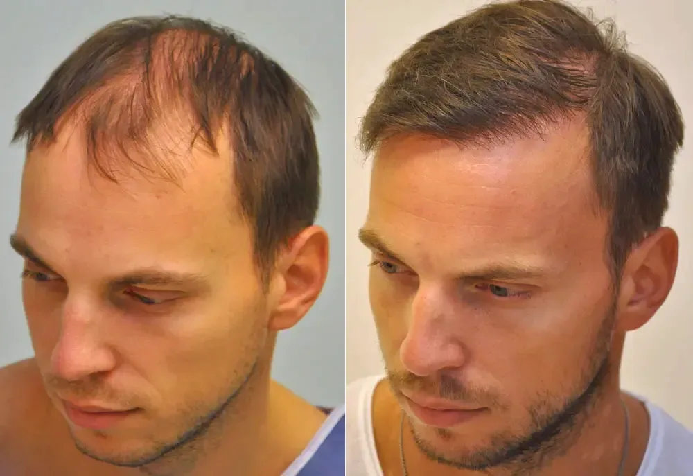 FUE by Doctor — Dr. Sikos Geza Clinic
