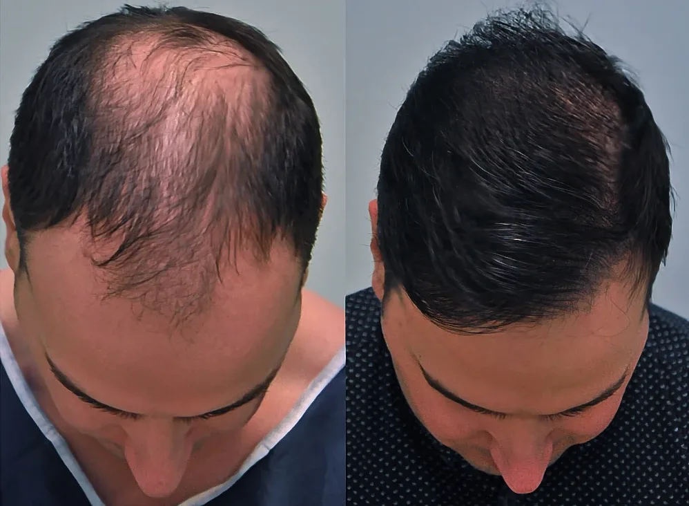 FUE by Doctor — Dr. Sikos Geza Clinic