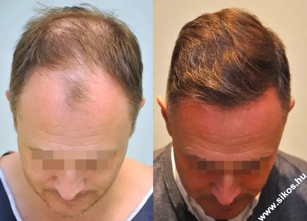 FUE by Doctor — Dr. Sikos Geza Clinic