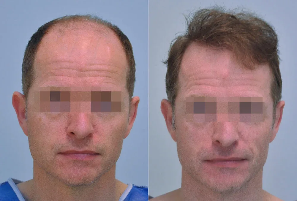 FUE by Doctor — Dr. Sikos Geza Clinic