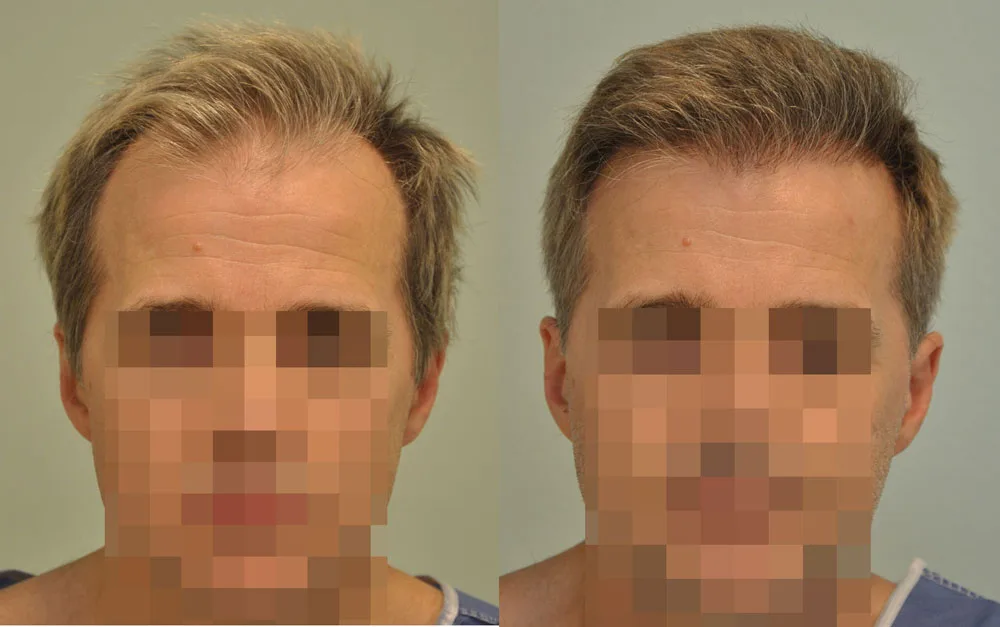 FUE by Doctor — Dr. Sikos Geza Clinic