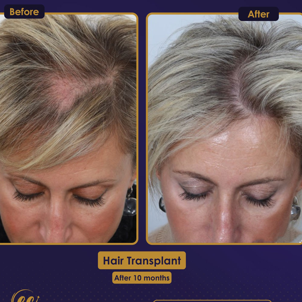 FUE — Estherian clinic