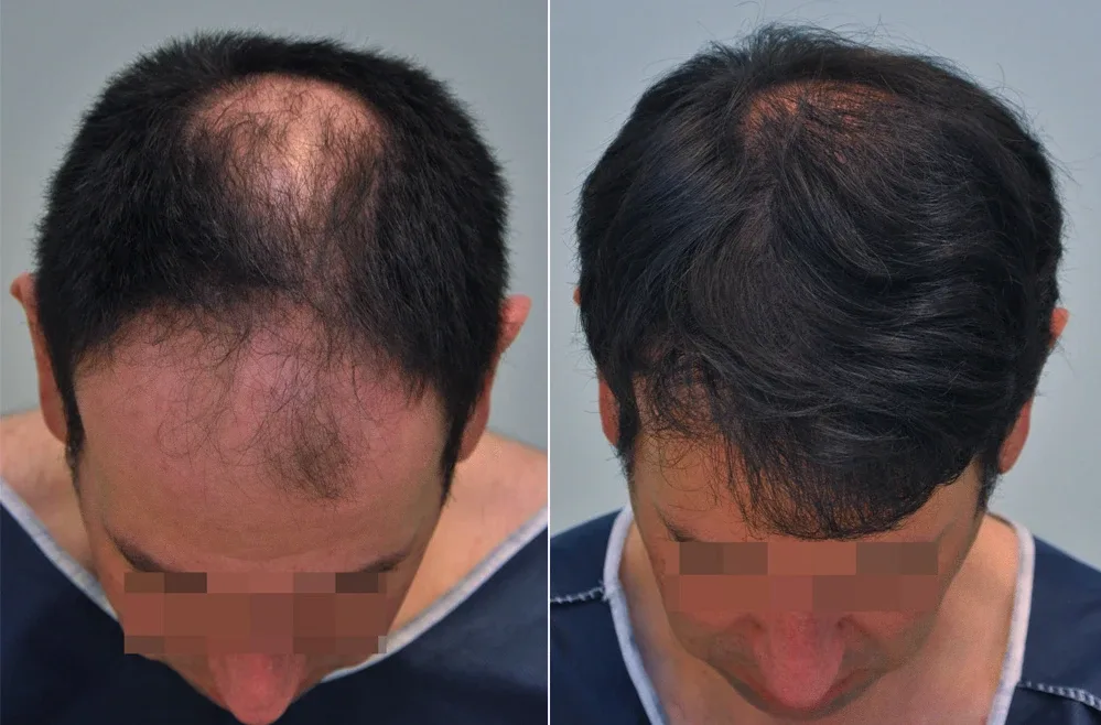 FUE by Doctor — Dr. Sikos Geza Clinic