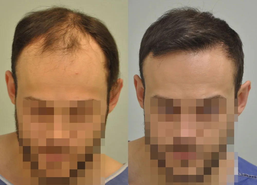 FUE by Doctor — Dr. Sikos Geza Clinic