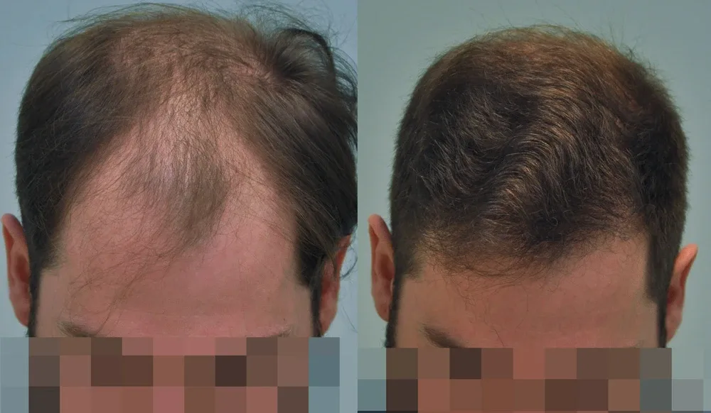 FUE by Doctor — Dr. Sikos Geza Clinic