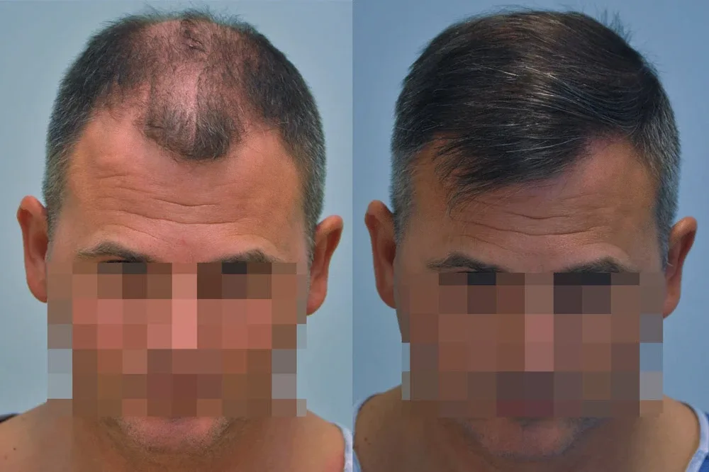 FUE by Doctor — Dr. Sikos Geza Clinic