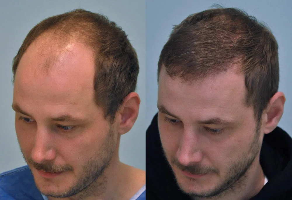 FUE by Doctor — Dr. Sikos Geza Clinic