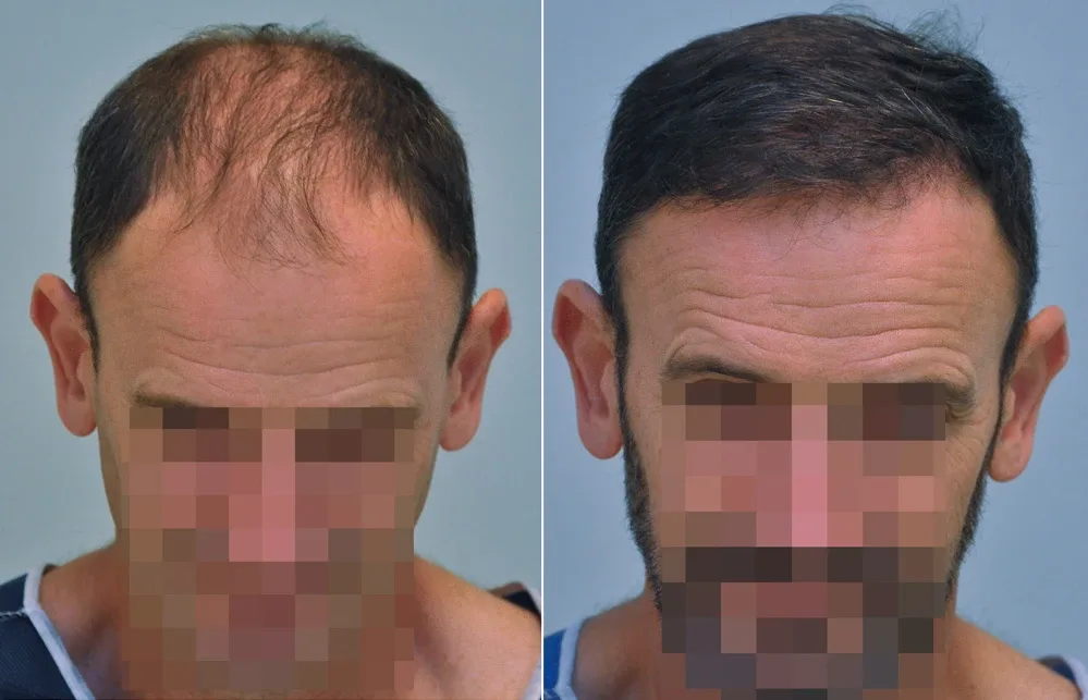 FUE by Doctor — Dr. Sikos Geza Clinic