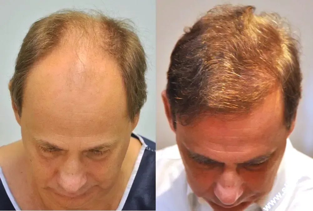 FUE by Doctor — Dr. Sikos Geza Clinic