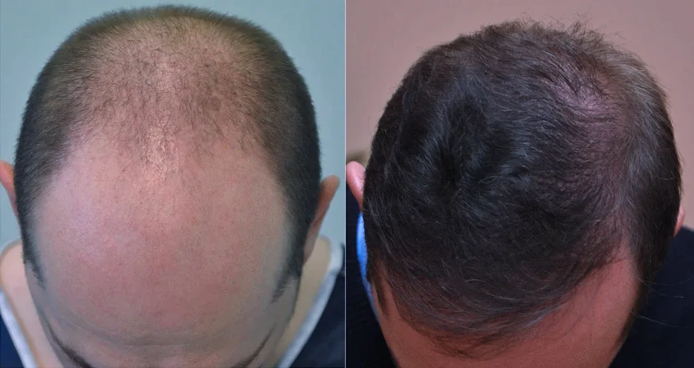 FUE by Doctor — Dr. Sikos Geza Clinic