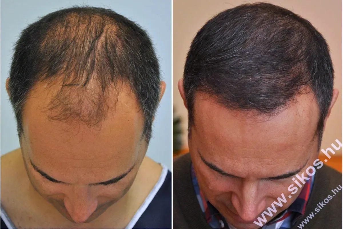 FUE by Doctor — Dr. Sikos Geza Clinic
