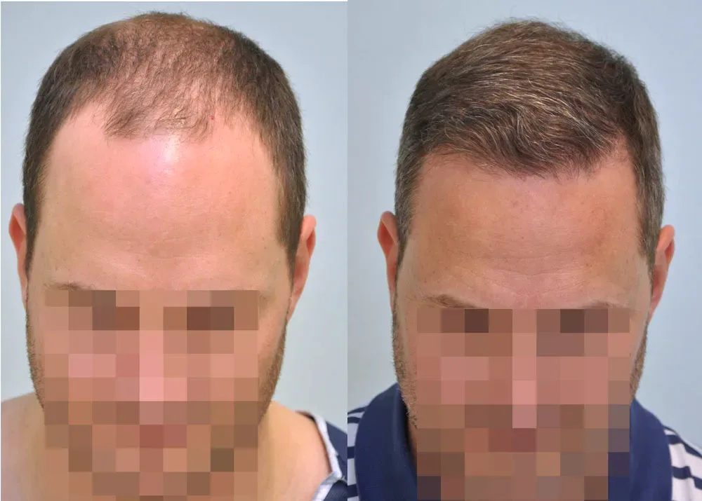 FUE by Doctor — Dr. Sikos Geza Clinic