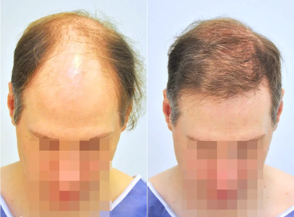 FUE by Doctor — Dr. Sikos Geza Clinic