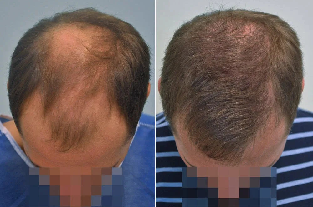 FUE by Doctor — Dr. Sikos Geza Clinic