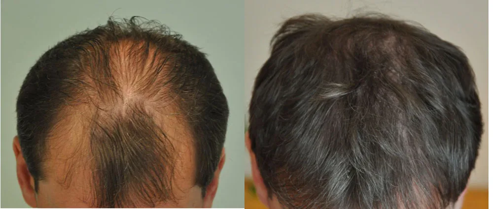 FUE by Doctor — Dr. Sikos Geza Clinic
