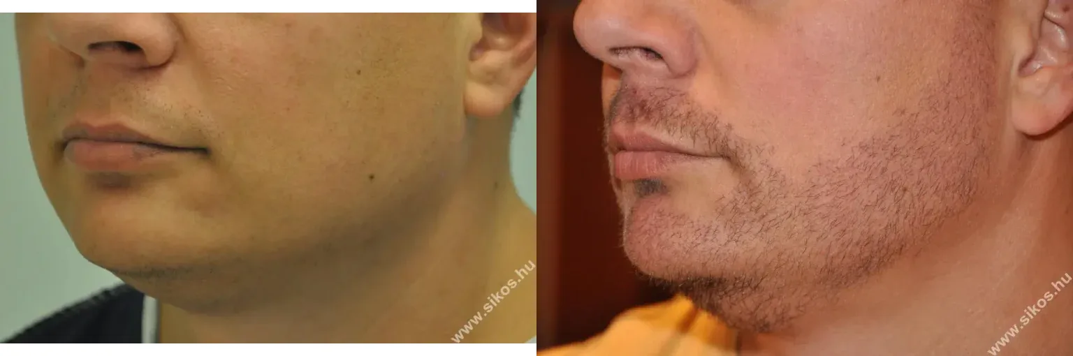 Beard Transplant — Dr. Sikos Geza Clinic