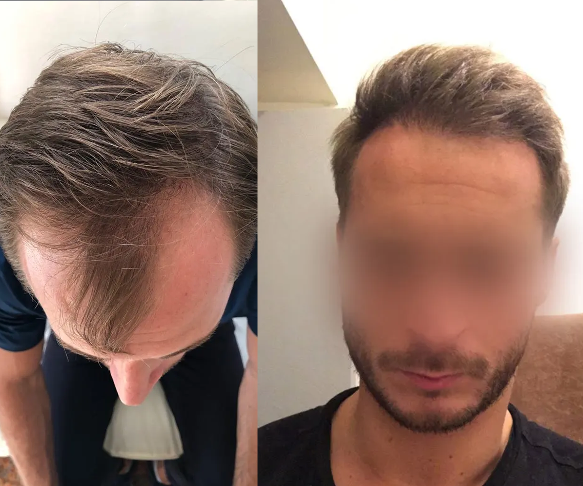 FUE — Dr Beyhan Zeybek Hair restoration expert