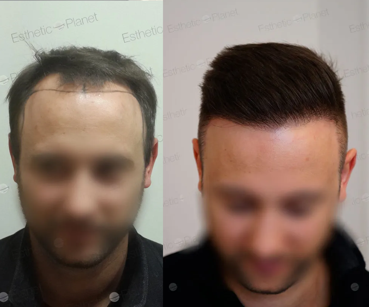 FUE — Dr Beyhan Zeybek Hair restoration expert