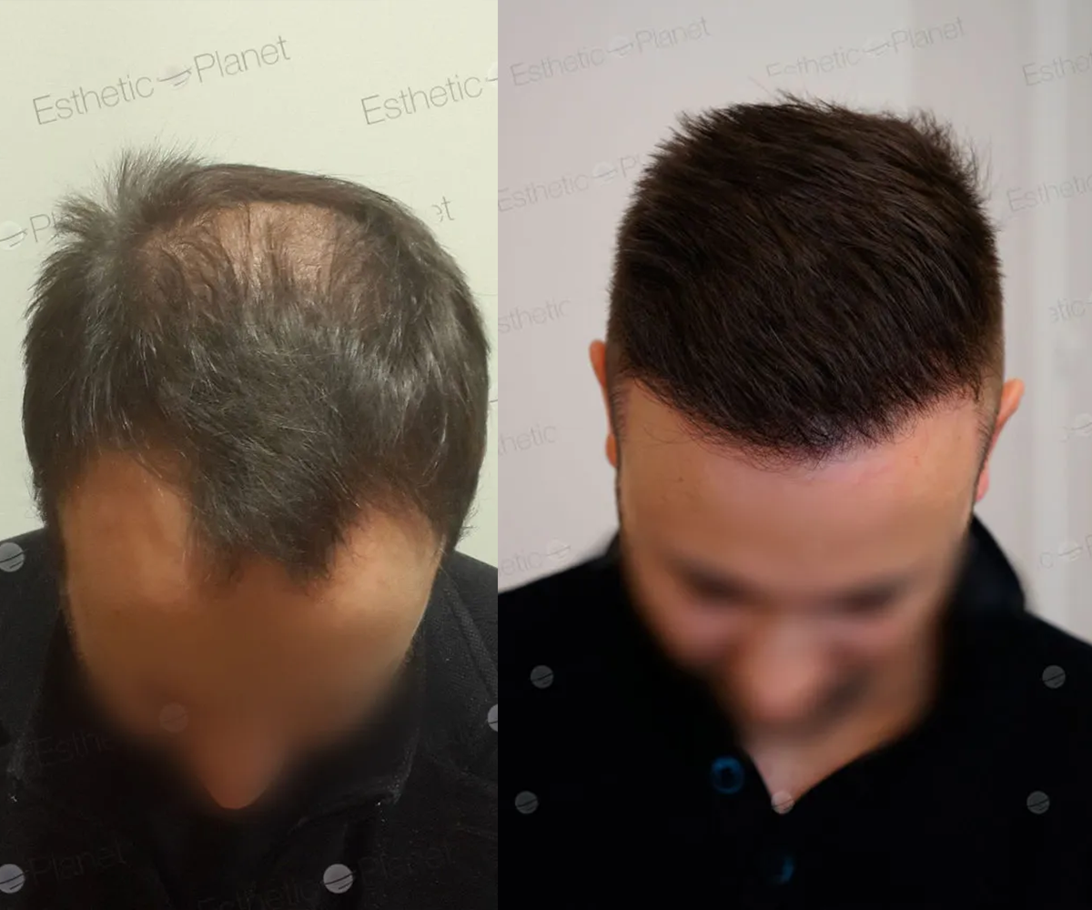 FUE — Dr Beyhan Zeybek Hair restoration expert