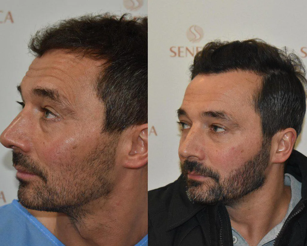 Beard Transplant — Seneca Medical Group