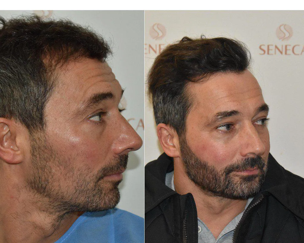 Beard Transplant — Seneca Medical Group