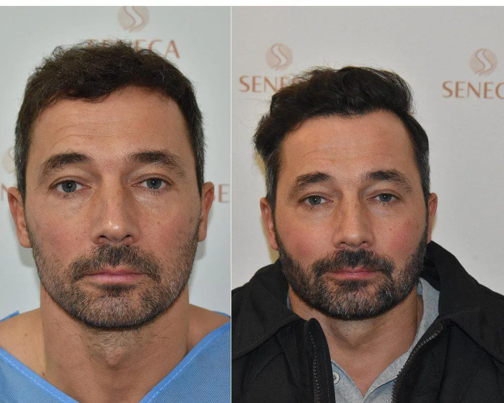 Beard Transplant — Seneca Medical Group