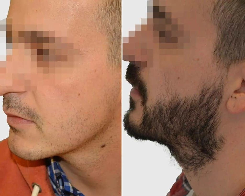 Beard Transplant — Seneca Medical Group