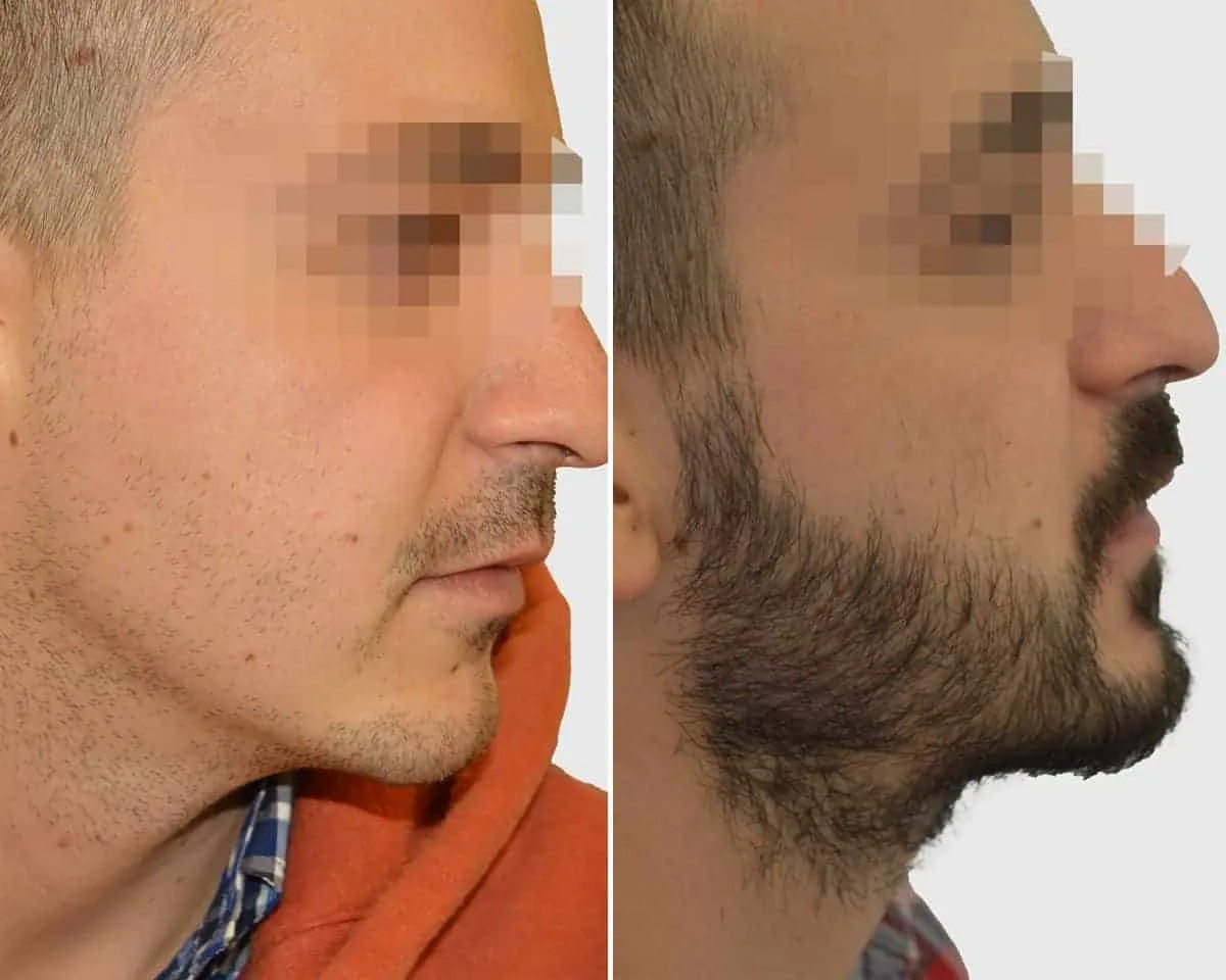 Beard Transplant — Seneca Medical Group