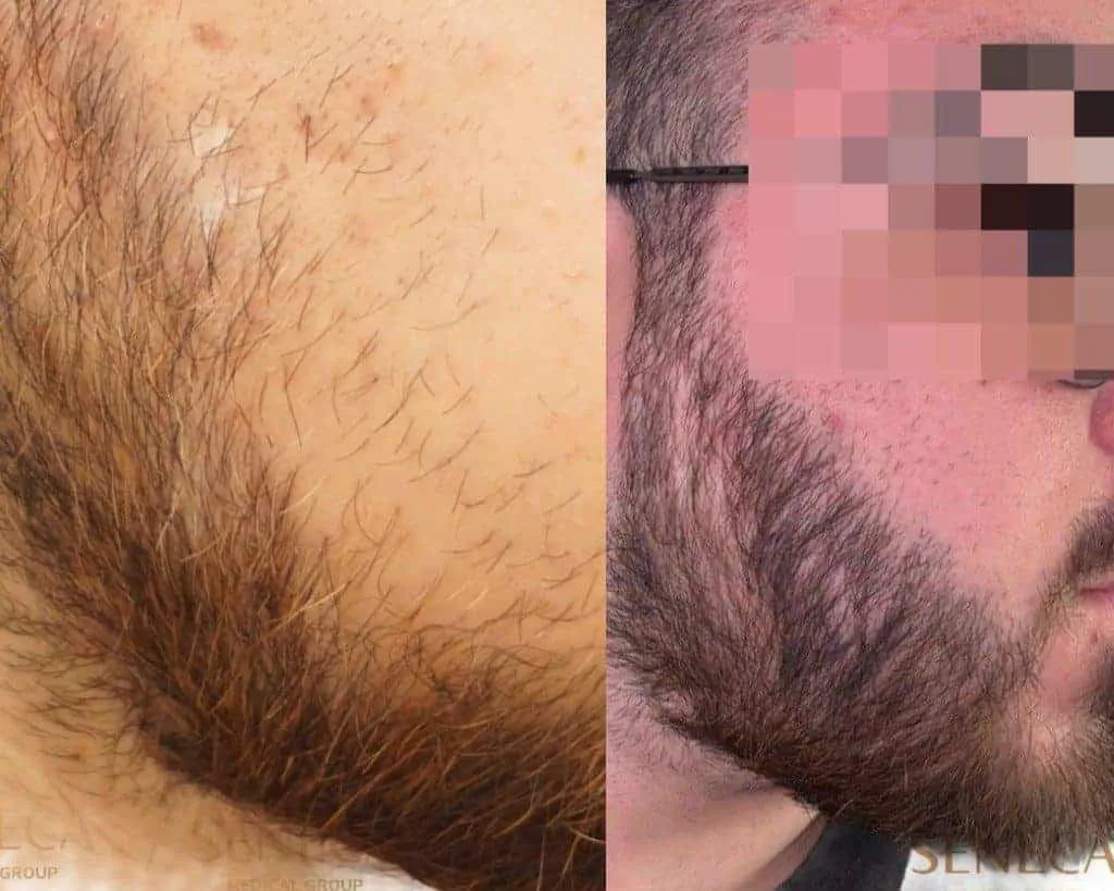 Beard Transplant — Seneca Medical Group
