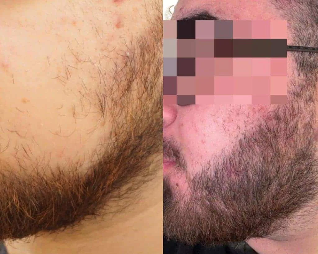 Beard Transplant — Seneca Medical Group