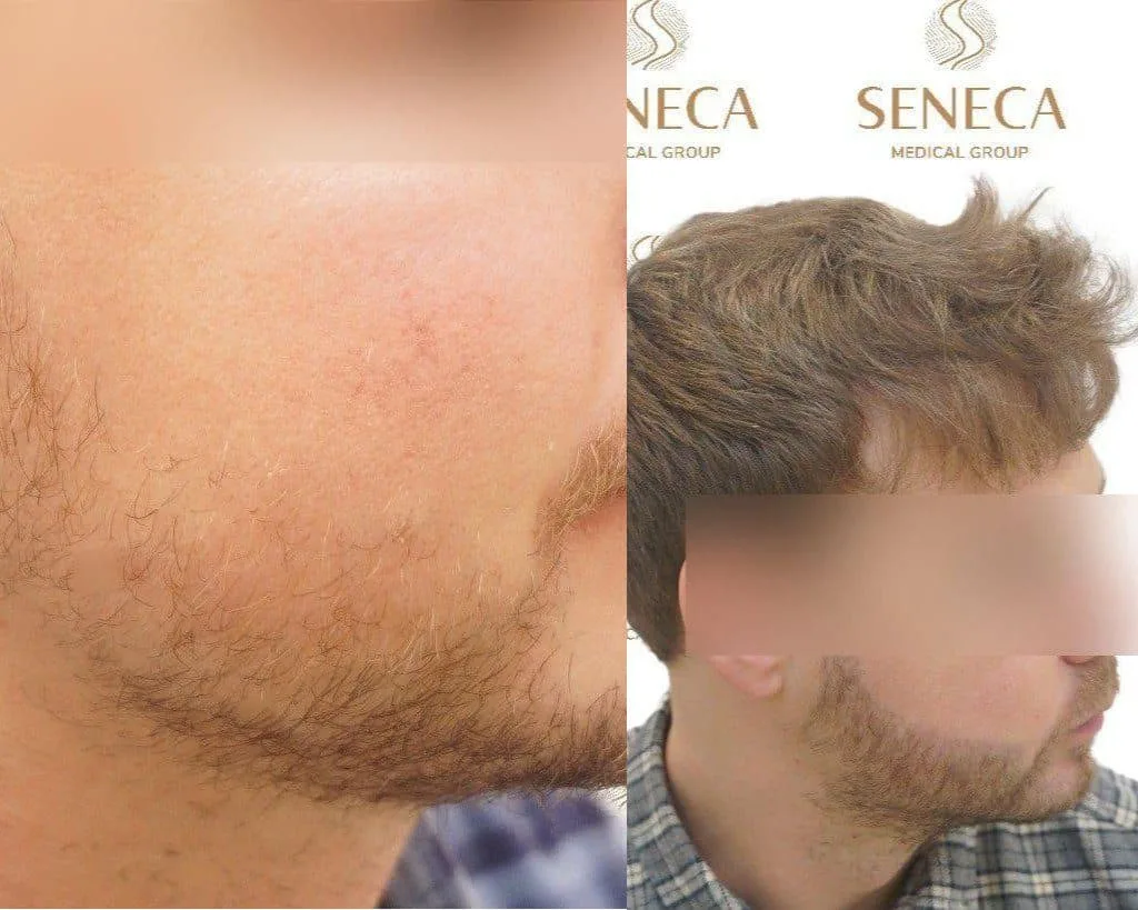 Beard Transplant — Seneca Medical Group