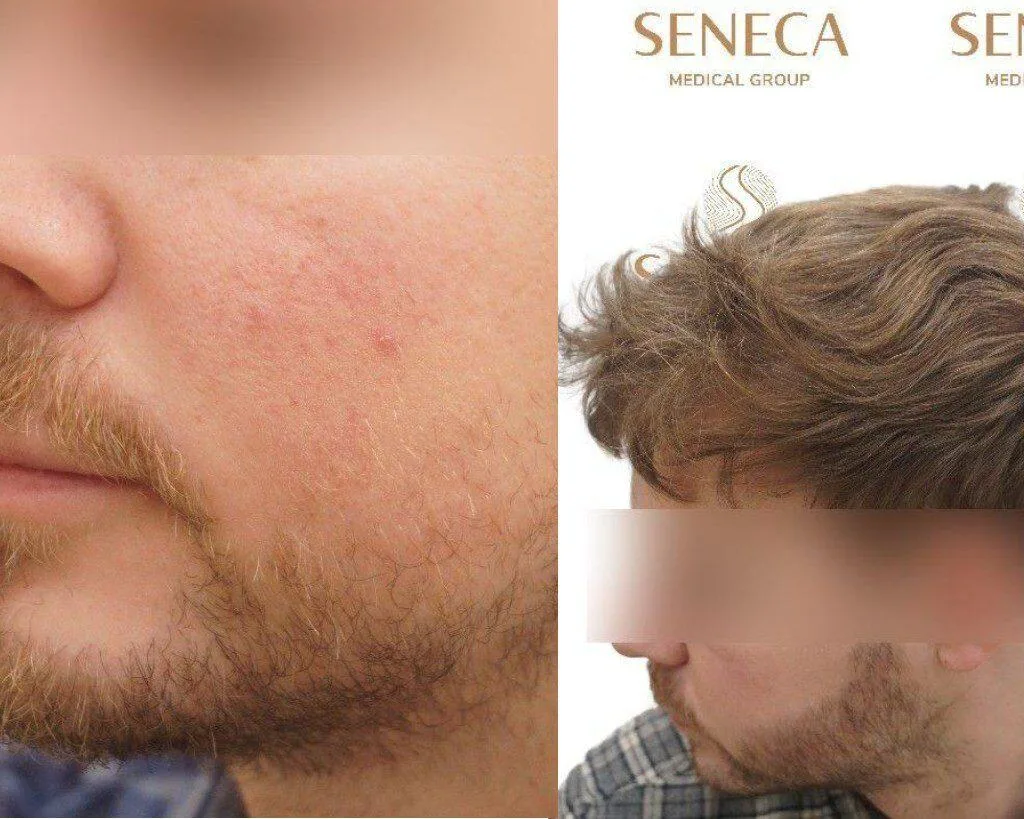 Beard Transplant — Seneca Medical Group