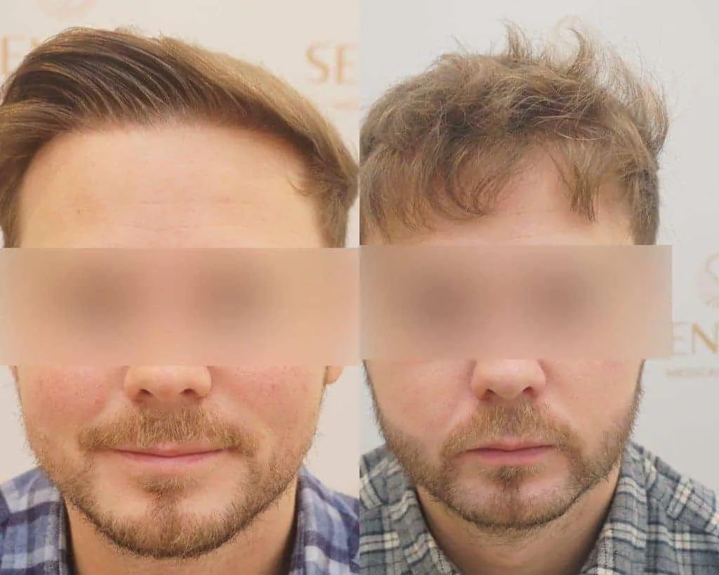 Beard Transplant — Seneca Medical Group