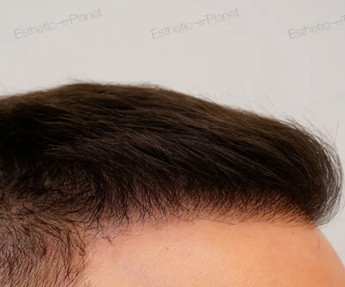 FUE — Dr Beyhan Zeybek Hair restoration expert