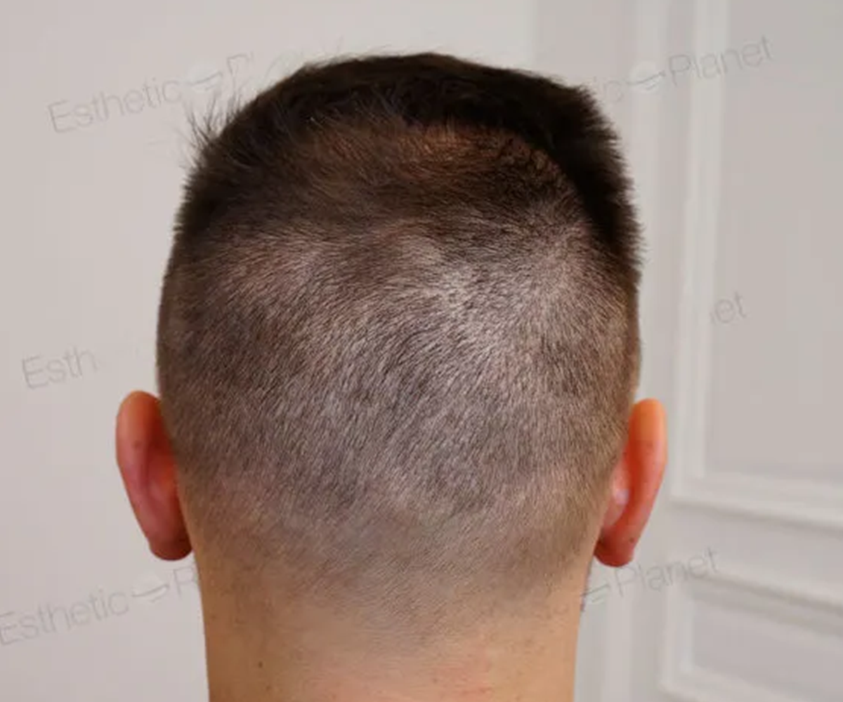 FUE — Dr Beyhan Zeybek Hair restoration expert