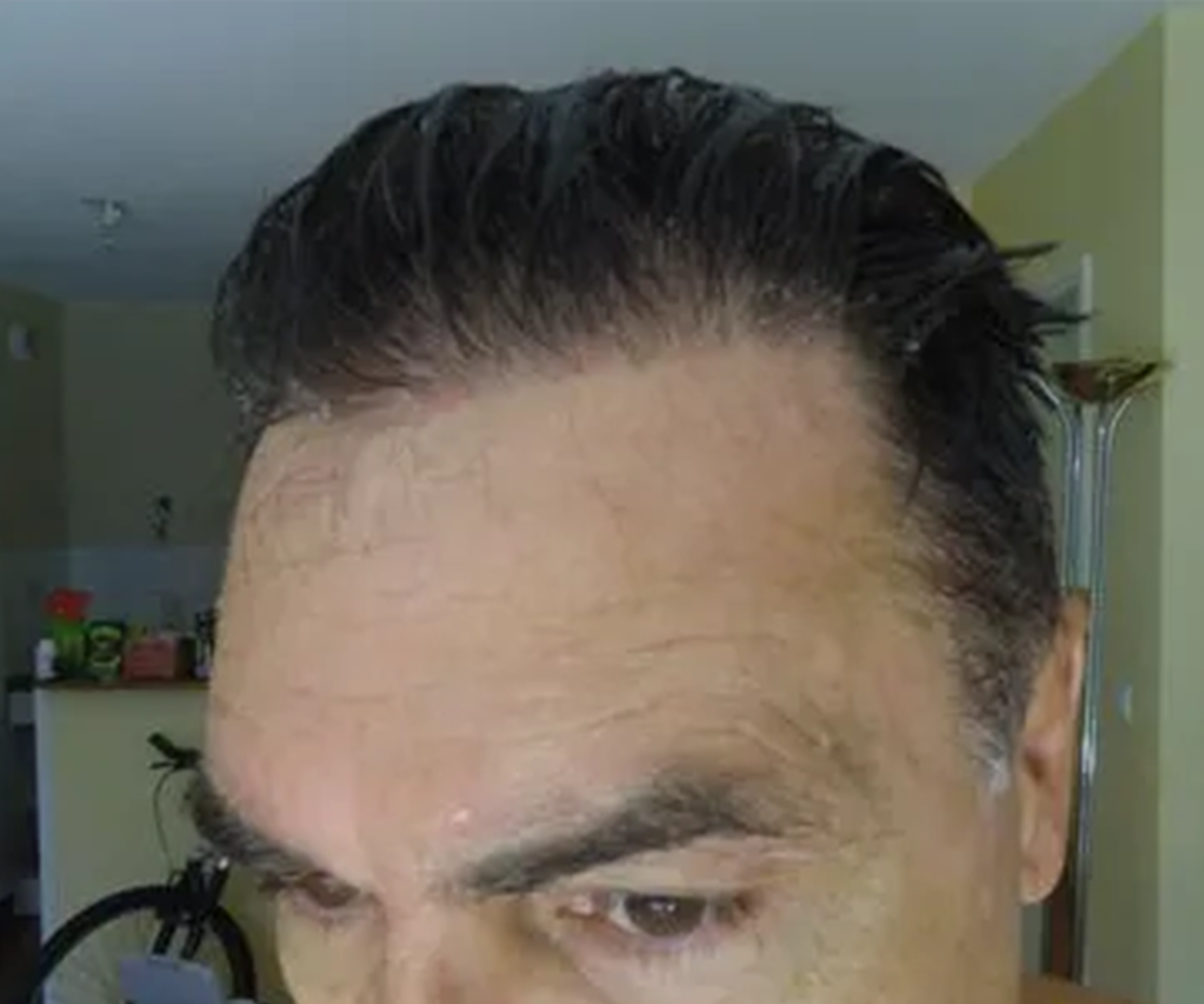 FUE — Dr Beyhan Zeybek Hair restoration expert