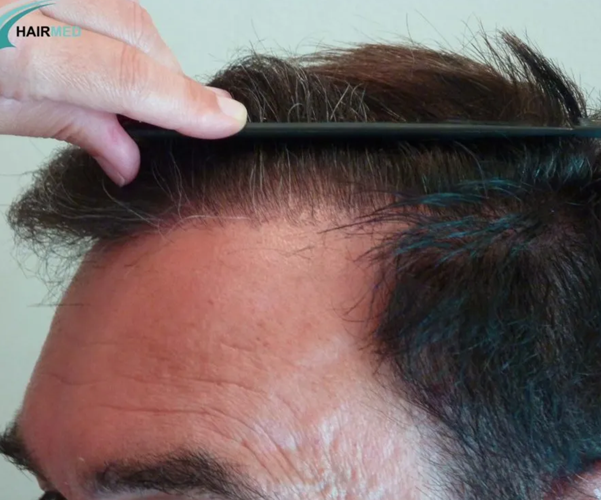 FUE — Dr Beyhan Zeybek Hair restoration expert