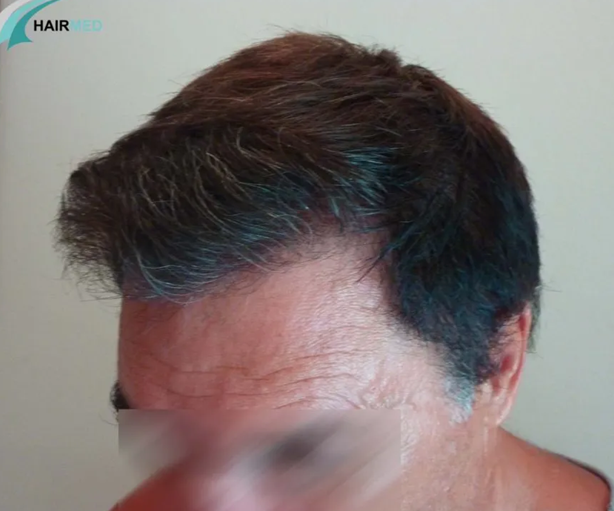 FUE — Dr Beyhan Zeybek Hair restoration expert
