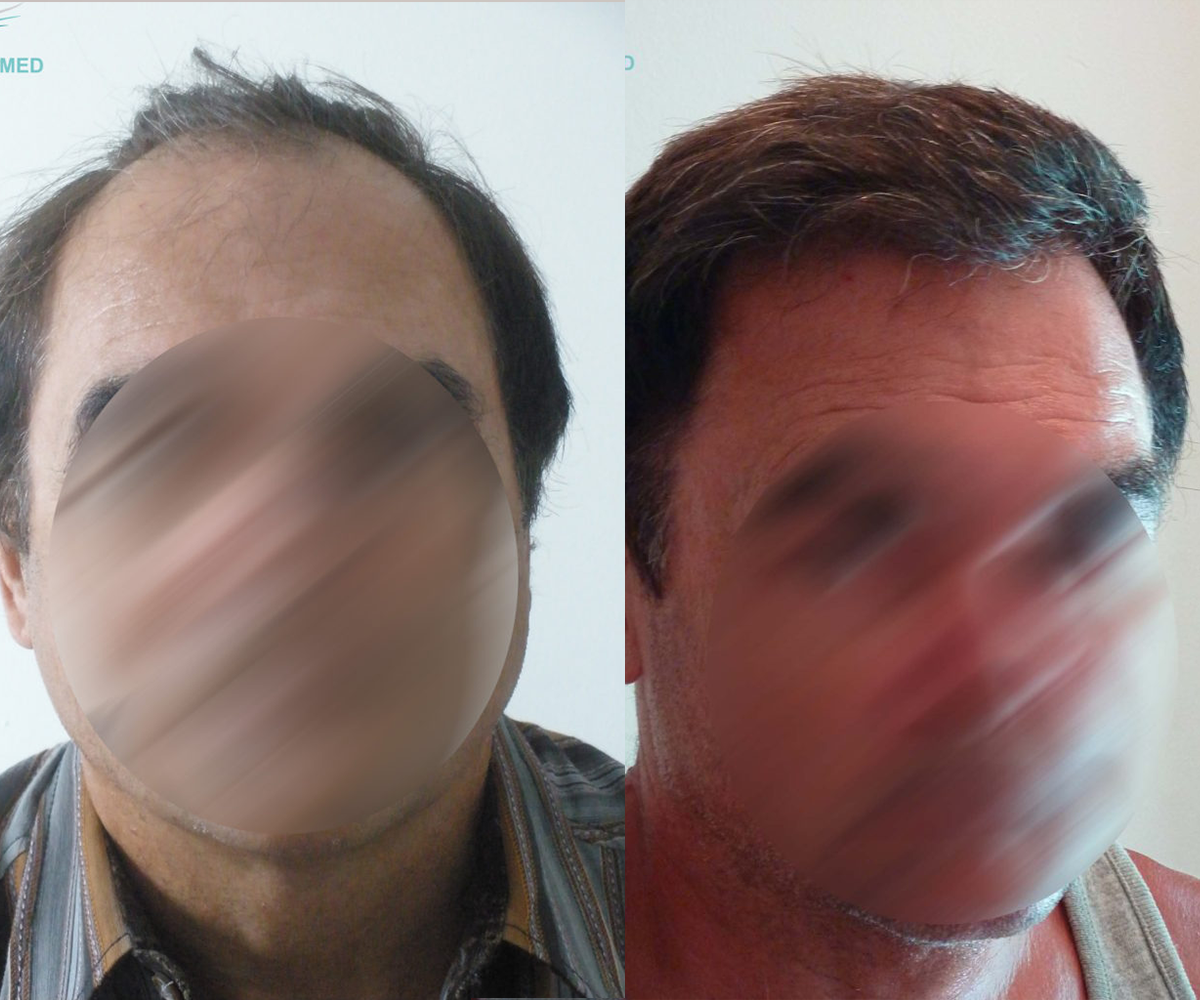 FUE — Dr Beyhan Zeybek Hair restoration expert