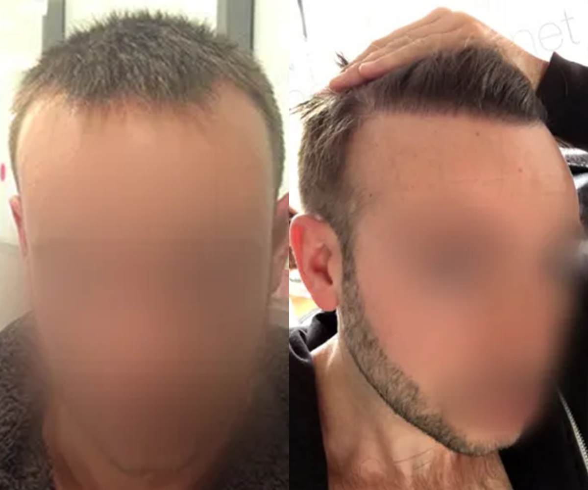FUE — Dr Beyhan Zeybek Hair restoration expert