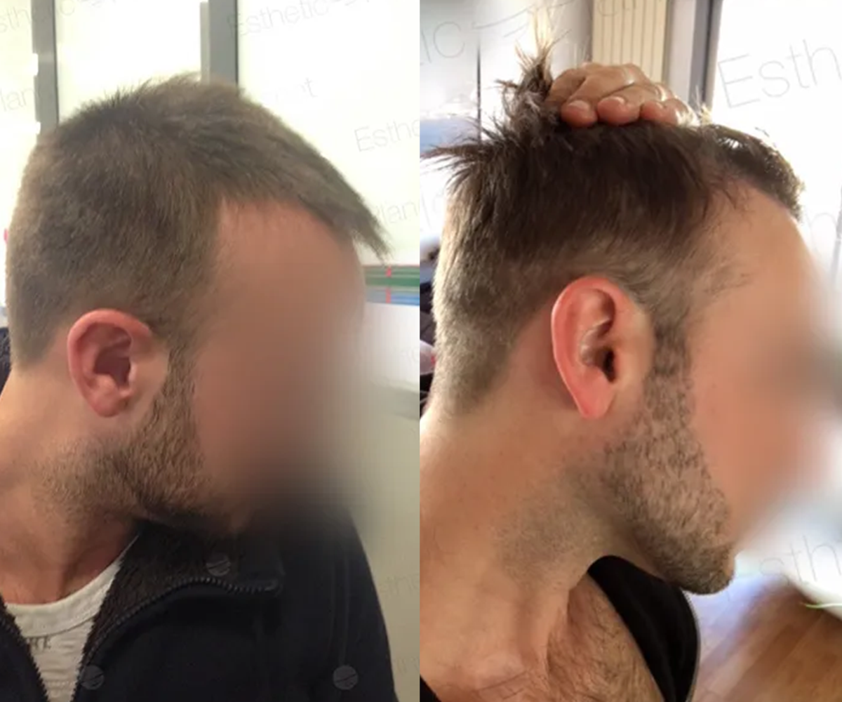 FUE — Dr Beyhan Zeybek Hair restoration expert