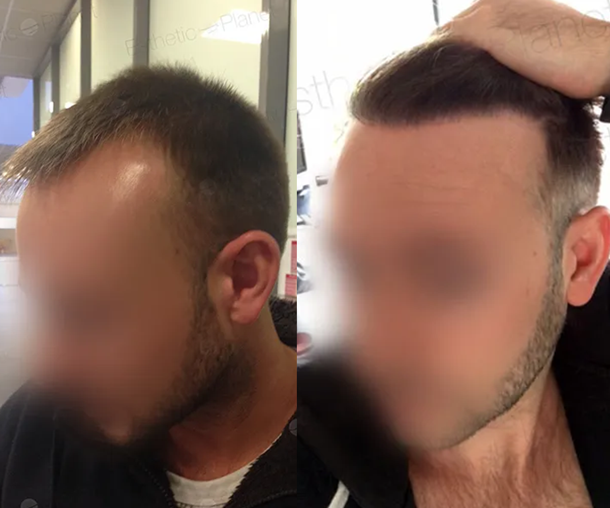 FUE — Dr Beyhan Zeybek Hair restoration expert