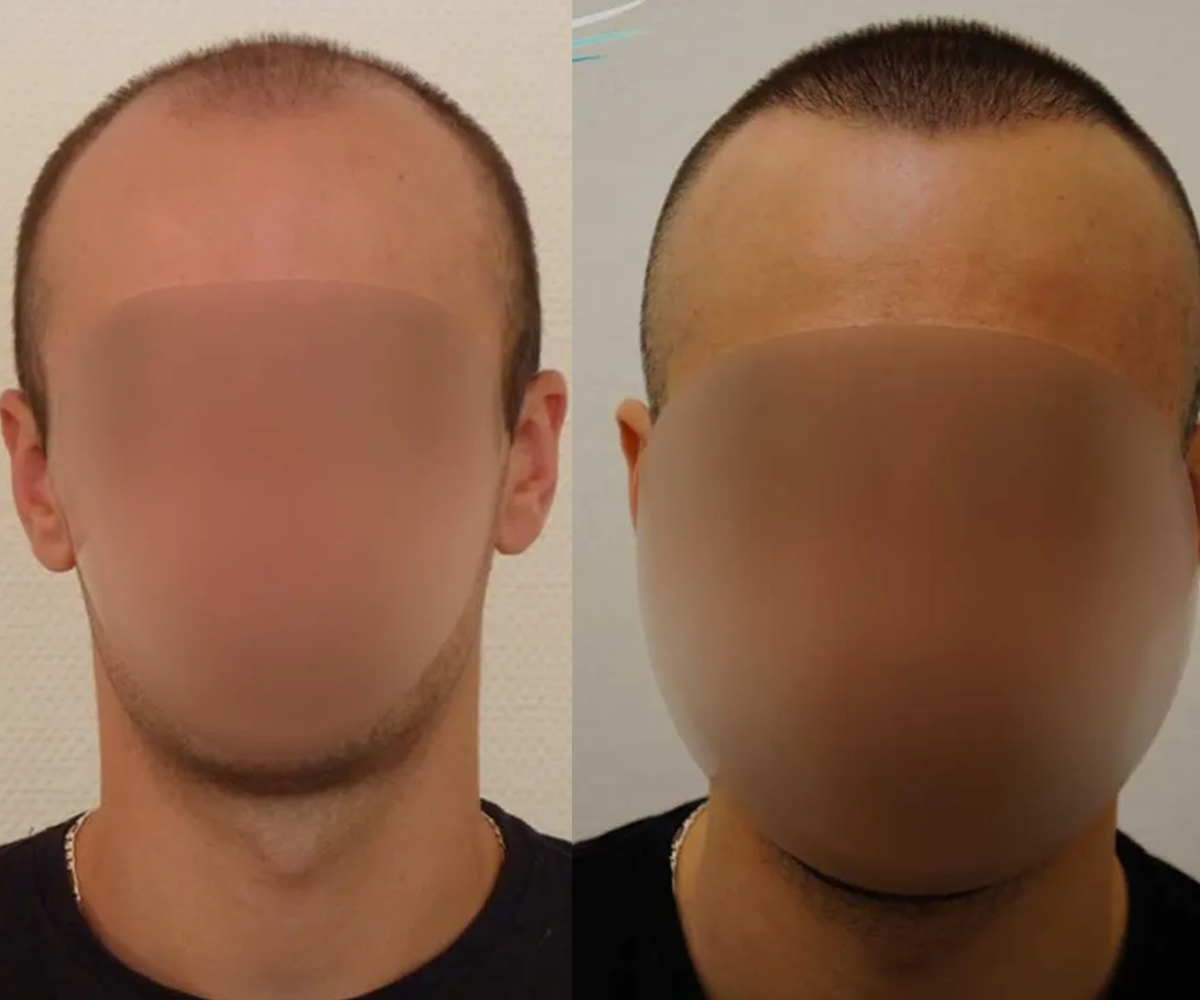 FUE — Dr Beyhan Zeybek Hair restoration expert