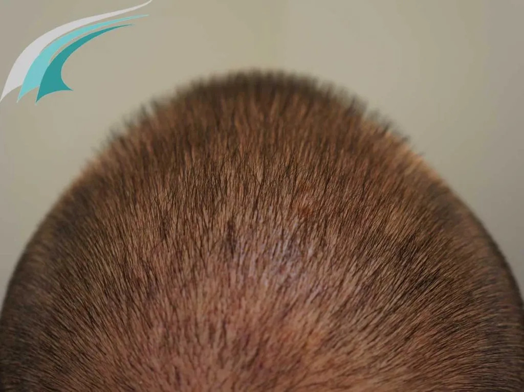 FUE — Dr Beyhan Zeybek Hair restoration expert