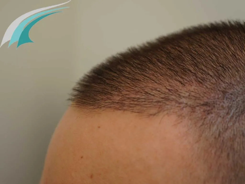 FUE — Dr Beyhan Zeybek Hair restoration expert