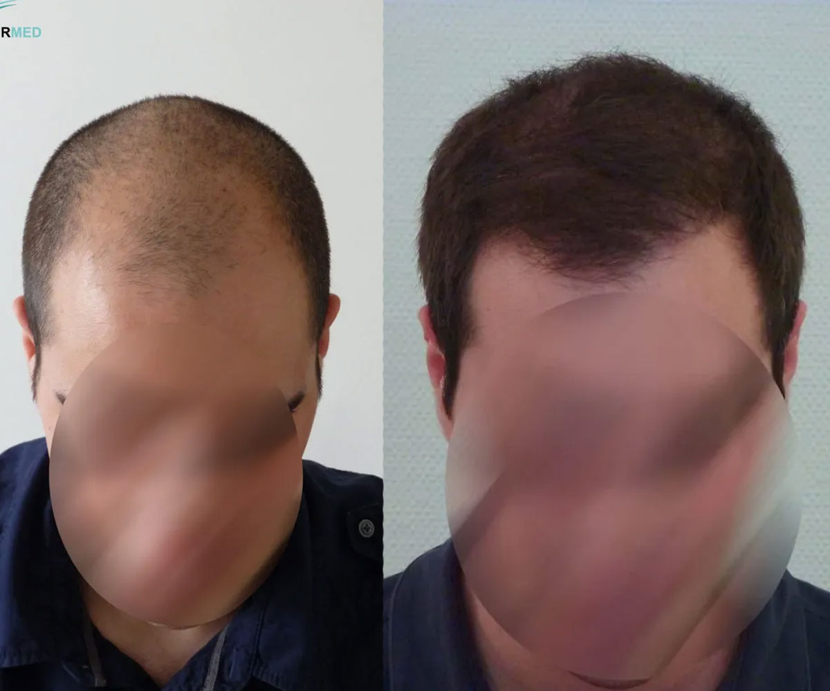FUE — Dr Beyhan Zeybek Hair restoration expert