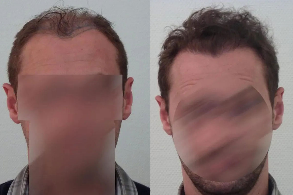 FUT — Dr Beyhan Zeybek Hair restoration expert
