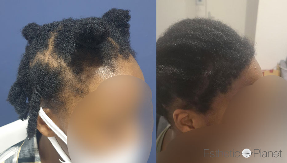 FUT — Dr Beyhan Zeybek Hair restoration expert
